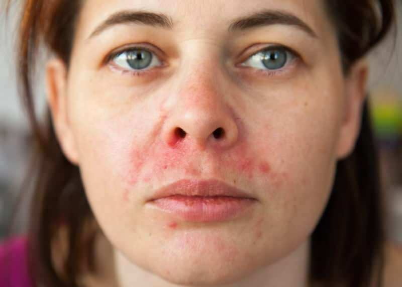 De ce apare acneea în jurul buzei? Cum se tratează dermatita periorală?
