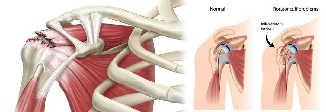 מדוע נוצר קרע בכתף? כיצד מטפלים בקרע בכתף?